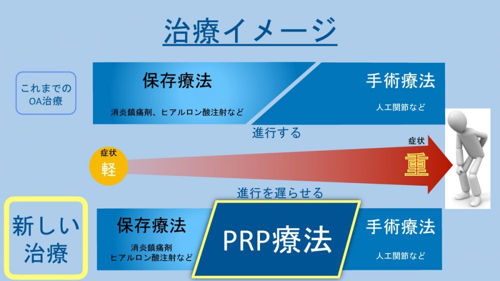 PRP-FDについて