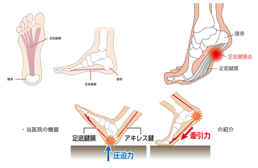 衝撃波治療とは